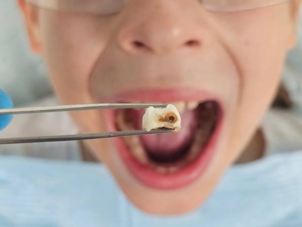 Best Emergency Root Canal Therapy in Petersburg, IL