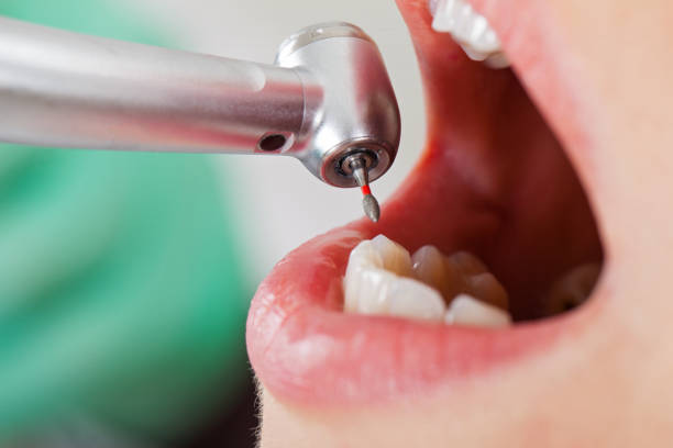 Best Emergency Dental Care for Sports Injuries in Petersburg, IL